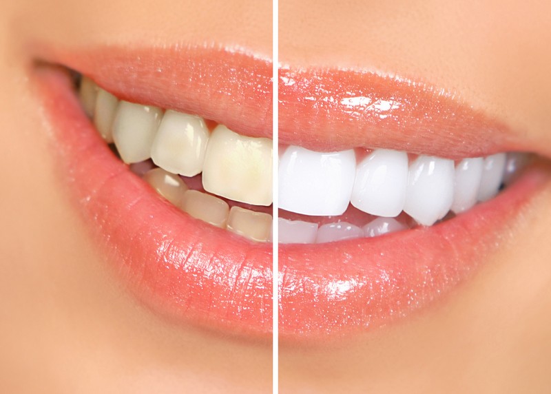 Teeth Whitening Beaverton, OR 